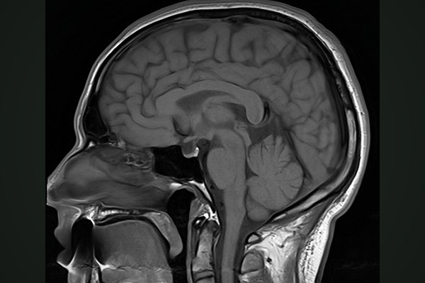 An MRI slice of a human head, ready to be stacked into 3D.