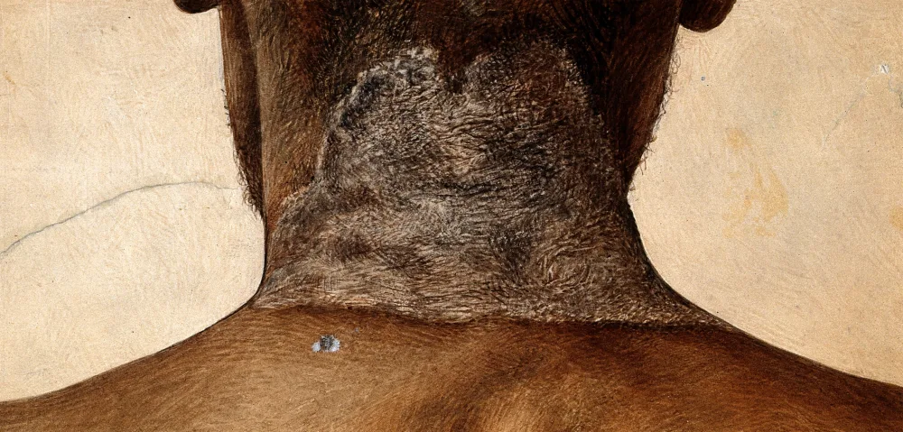 A medical watercolour of reddened, cracked dermatitis across the back of a person's neck, the skin sign of chronic pellagra.