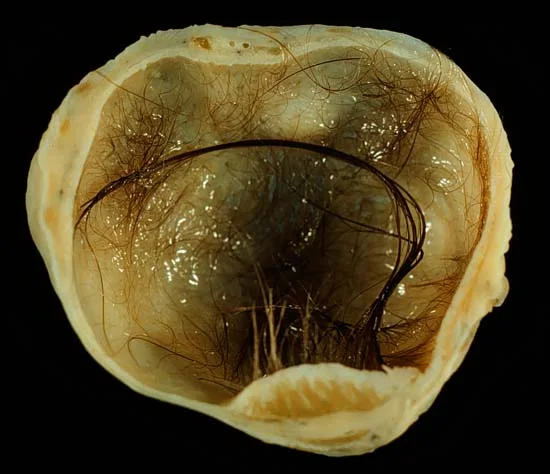 A surgically removed ovarian teratoma cut open, showing a mass of hair and a single formed tooth.