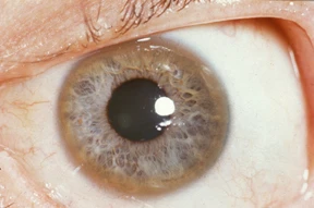 A close-up of a human eye showing a brownish copper-colored ring around the outer edge of the iris.