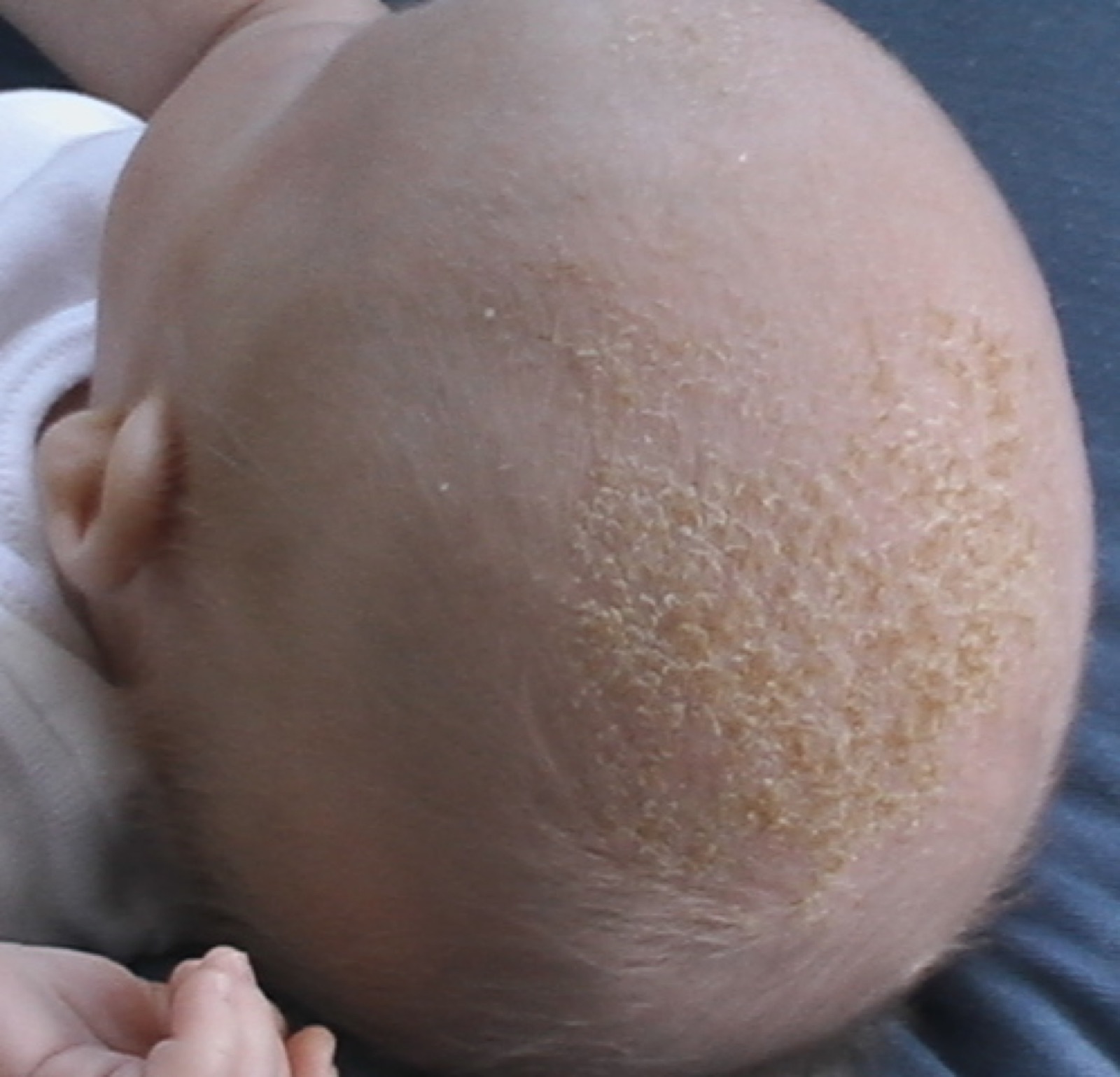 A patch of yellow-white, greasy, flaky scale on a baby's scalp, the typical look of cradle cap.