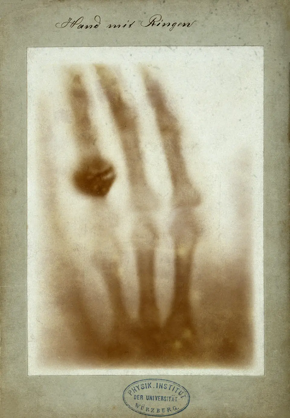 The first medical X-ray, 1895: the bones of a hand with two dark rings floating around the shadow of a finger.